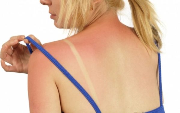 Τι συμβαίνει στο σώμα μας όταν καιγόμαστε από τον ήλιο;