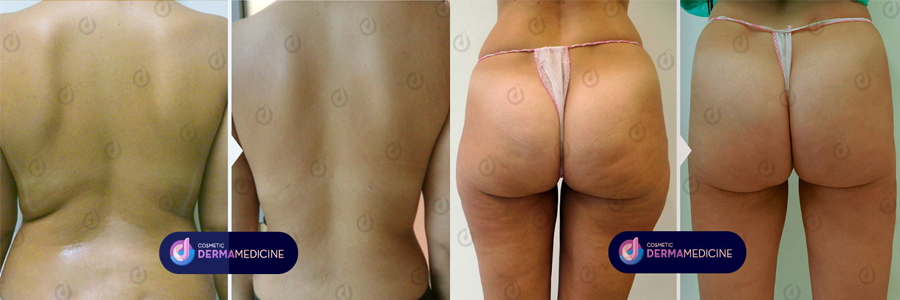 CDM Smartlipo Before After